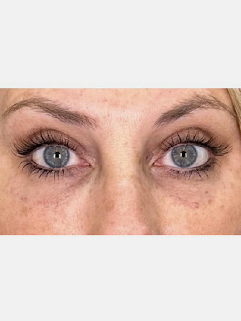 Filler Before & After Gallery - Patient 125873 - Image 2