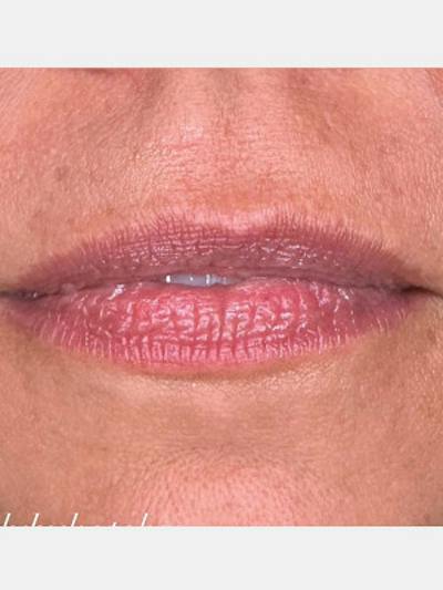Filler Before & After Gallery - Patient 205725 - Image 1