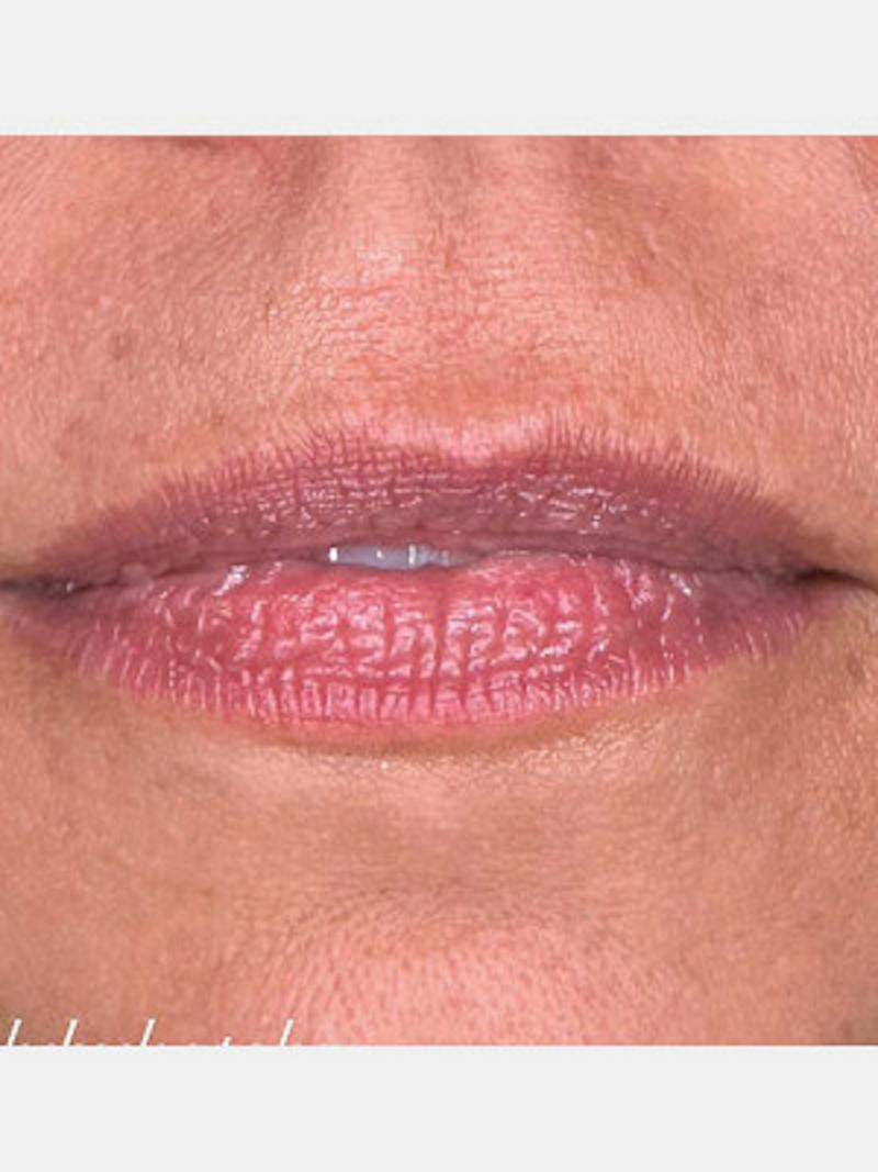 Filler Before & After Gallery - Patient 205725 - Image 1