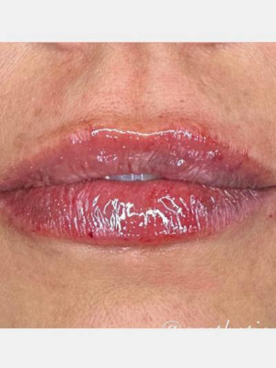 Filler Before & After Gallery - Patient 205725 - Image 2