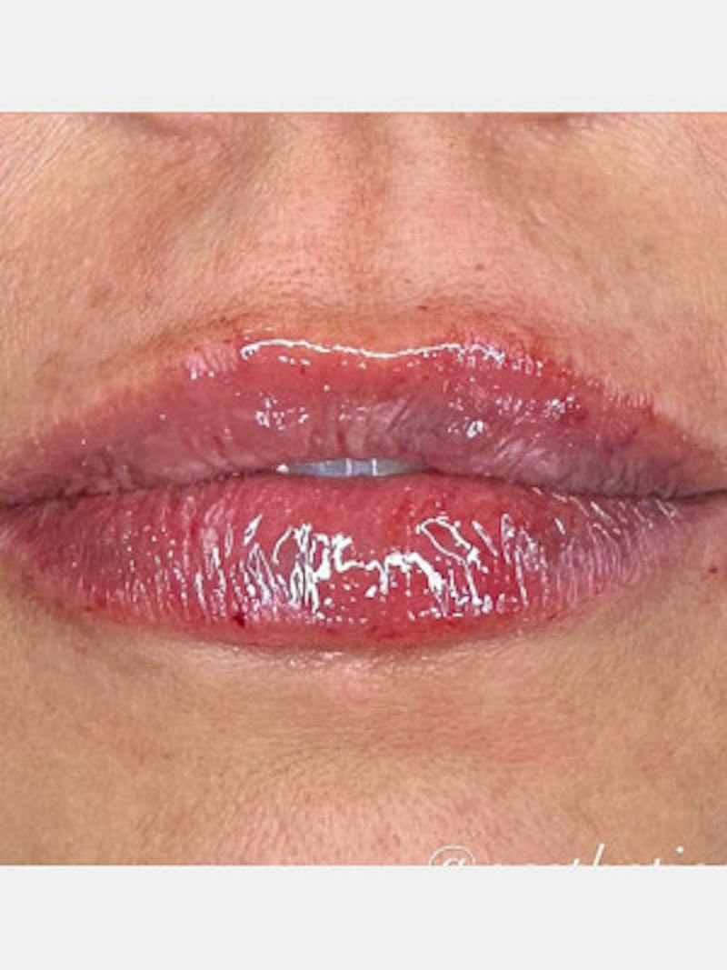 Filler Before & After Gallery - Patient 205725 - Image 2