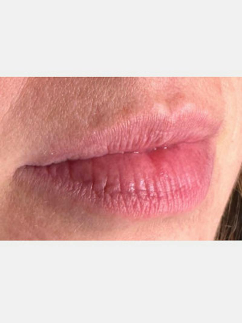 Filler Before & After Gallery - Patient 407241 - Image 1