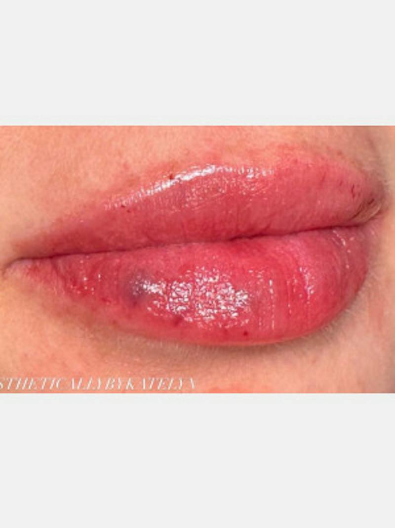 Filler Before & After Gallery - Patient 407241 - Image 2