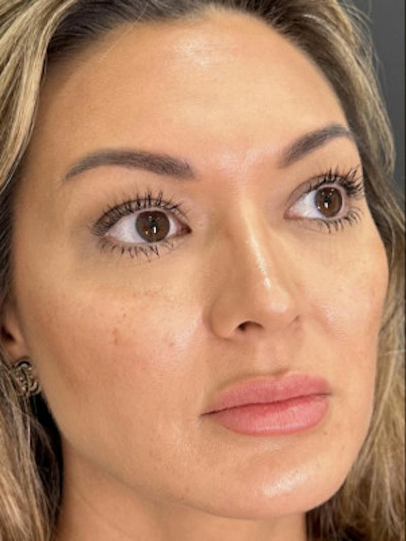 Filler Before & After Gallery - Patient 300099 - Image 1