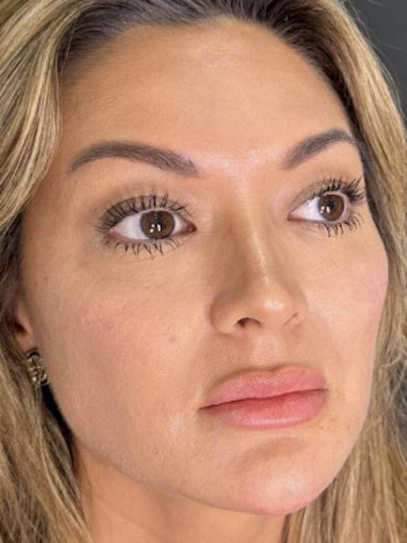 Filler Before & After Gallery - Patient 300099 - Image 2