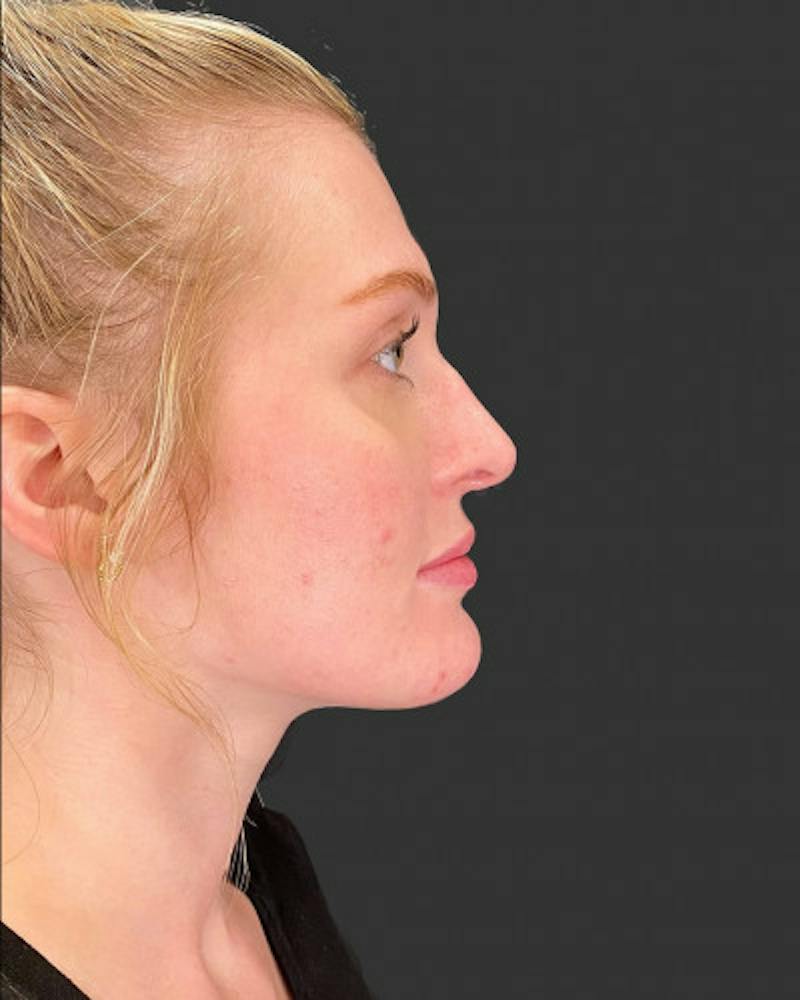 Filler Before & After Gallery - Patient 367432 - Image 1