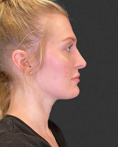 Filler Before & After Gallery - Patient 367432 - Image 2