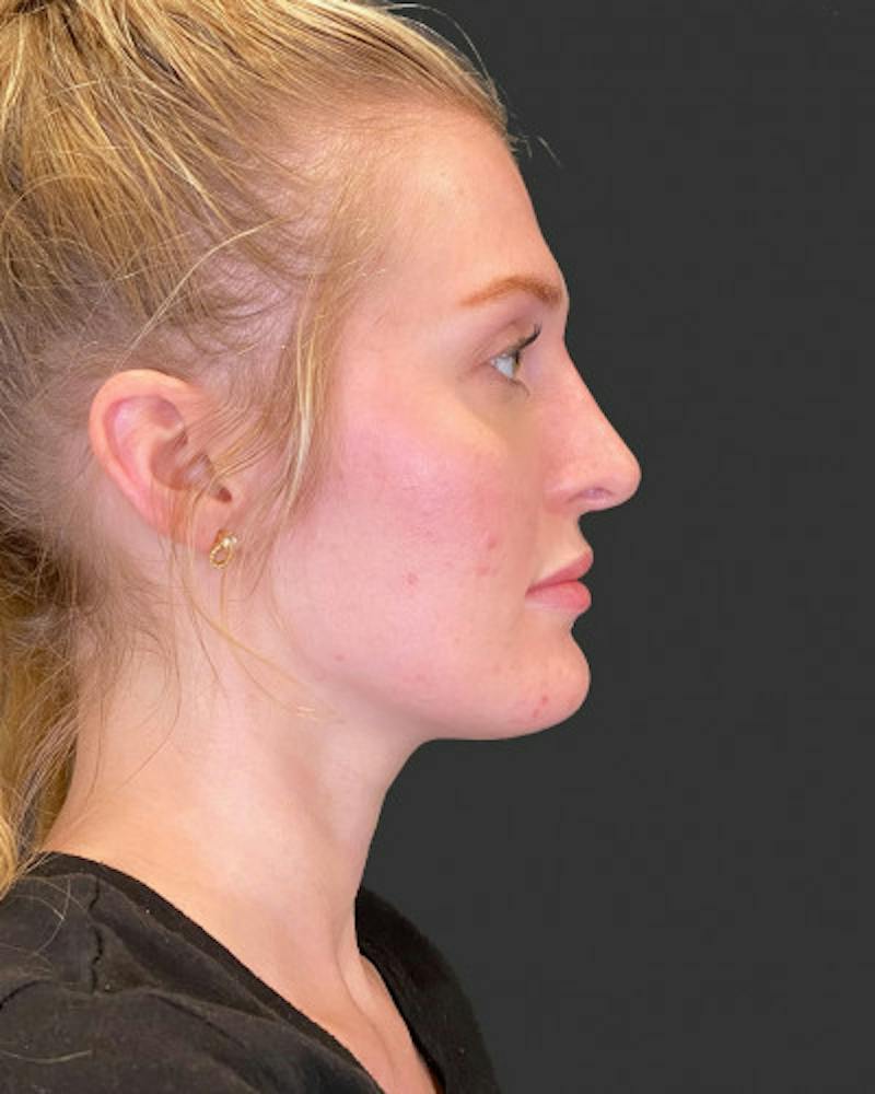 Filler Before & After Gallery - Patient 367432 - Image 2