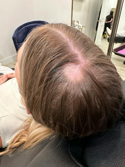 Hair Restoration Before & After Gallery - Patient 856774 - Image 1