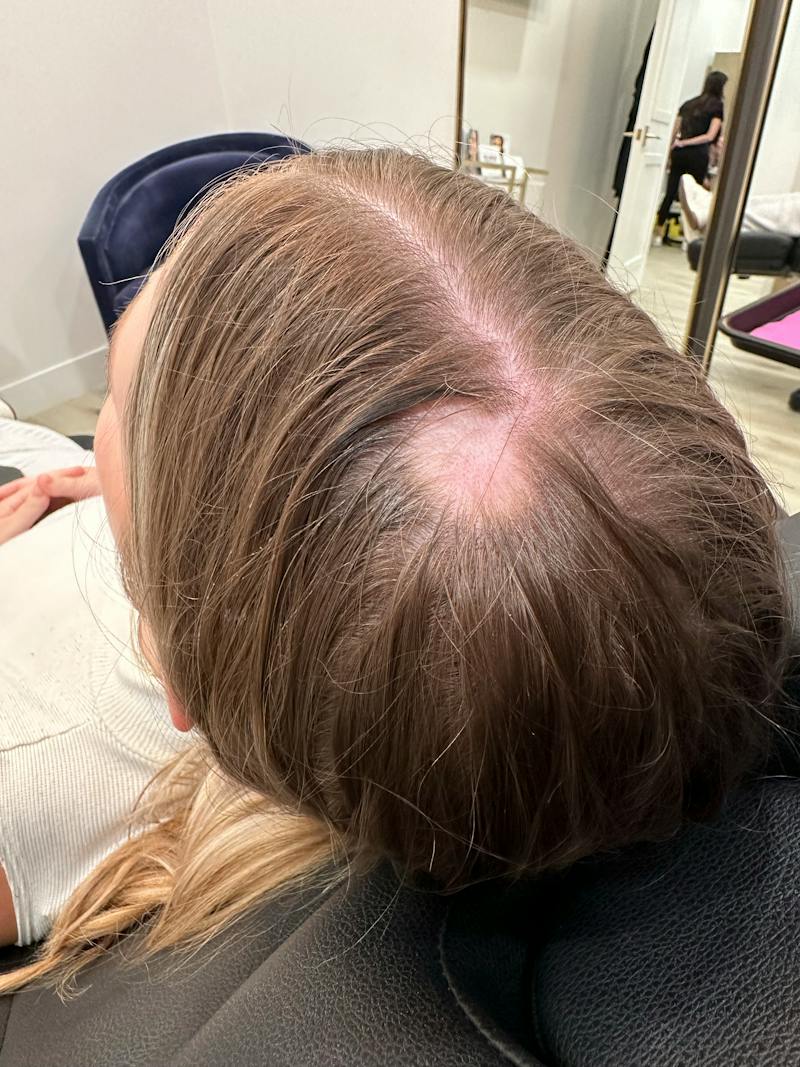 Hair Restoration Before & After Gallery - Patient 856774 - Image 1