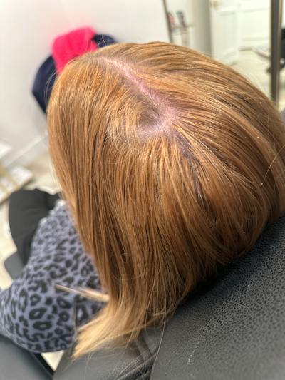 Hair Restoration Before & After Gallery - Patient 856774 - Image 2