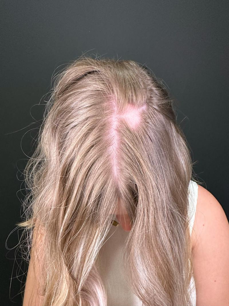 Hair Restoration Before & After Gallery - Patient 856774 - Image 3
