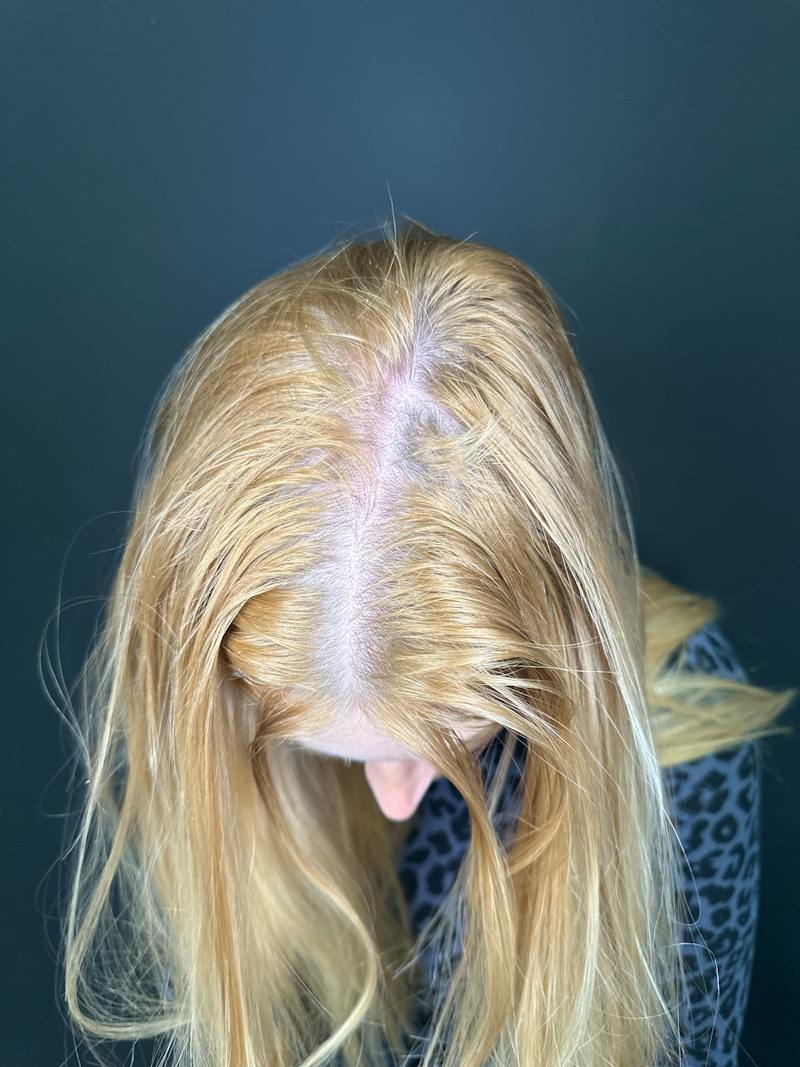 Hair Restoration Before & After Gallery - Patient 856774 - Image 4