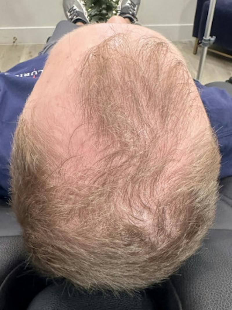 Hair Restoration Before & After Gallery - Patient 288888 - Image 1