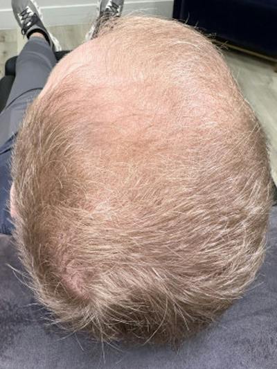 Hair Restoration Before & After Gallery - Patient 288888 - Image 2