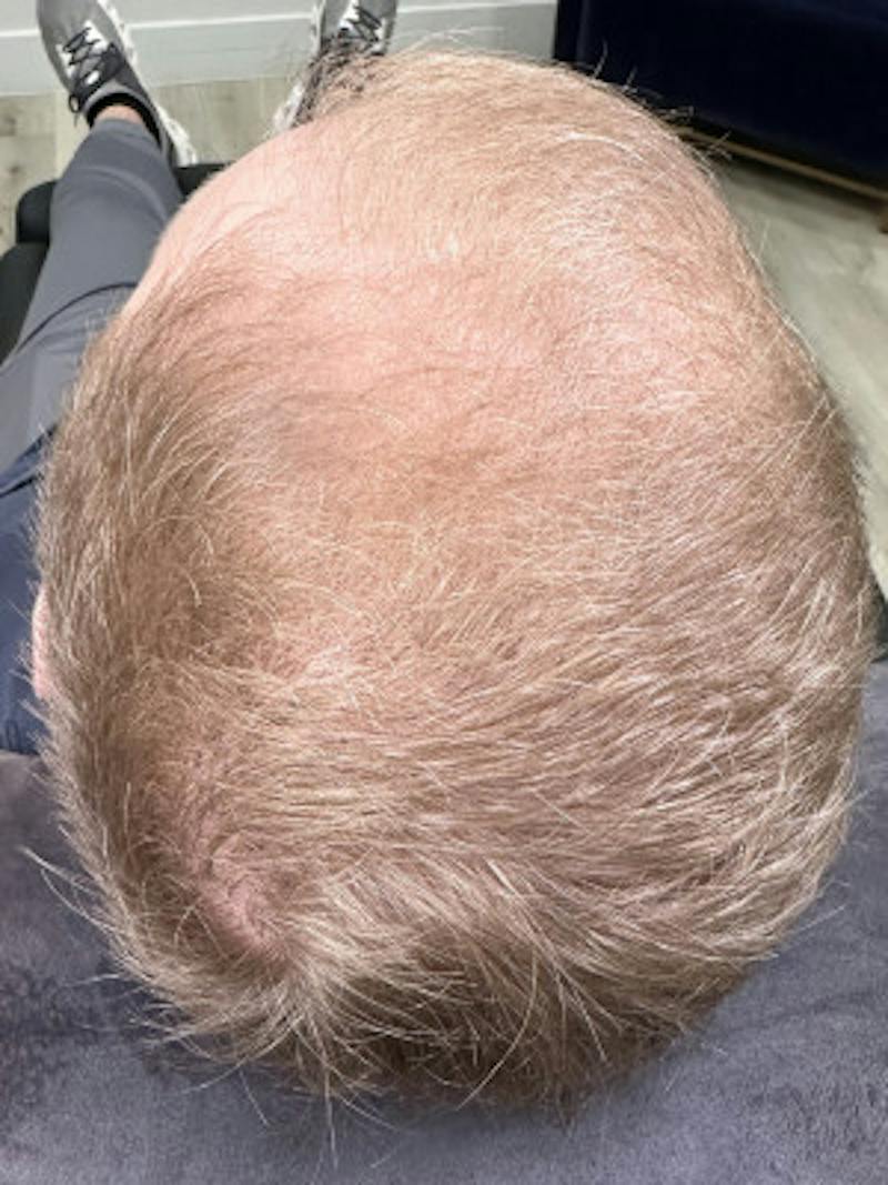 Hair Restoration Before & After Gallery - Patient 288888 - Image 2