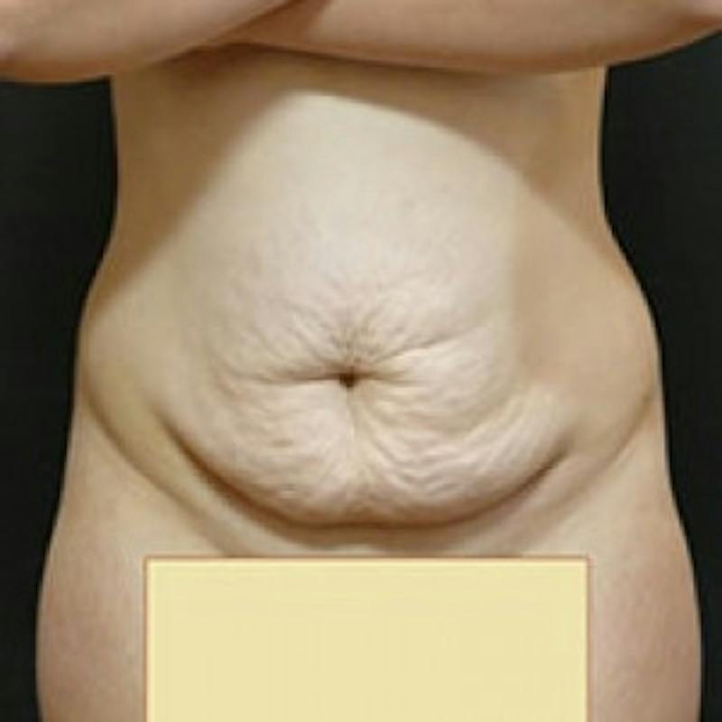 Post Massive Weight Loss Before & After Gallery - Patient 145431 - Image 1