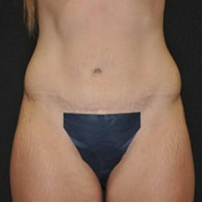 Post Massive Weight Loss Before & After Gallery - Patient 145431 - Image 2