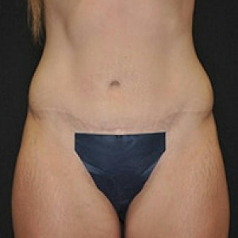 Post Massive Weight Loss Before & After Gallery - Patient 145431 - Image 2