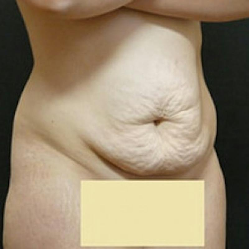 Post Massive Weight Loss Before & After Gallery - Patient 145431 - Image 3