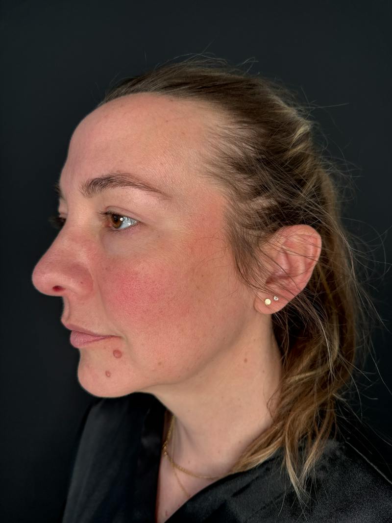 Upper + Lower Blepharoplasty Before & After Gallery - Patient 145946 - Image 2