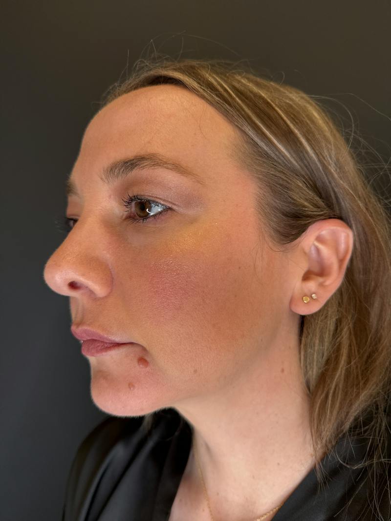 Upper + Lower Blepharoplasty Before & After Gallery - Patient 145946 - Image 1