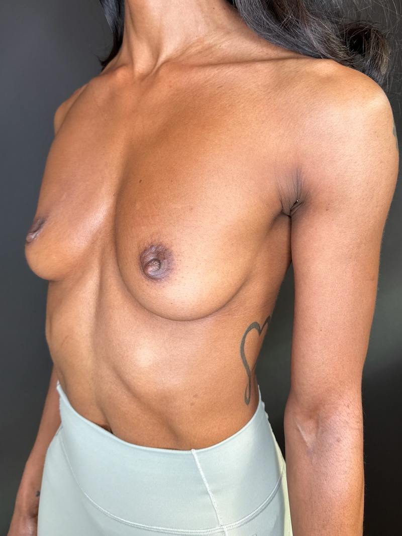 Breast Augmentation Before & After Gallery - Patient 162499 - Image 3