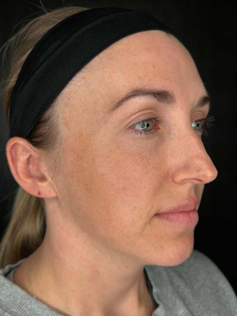 Upper + Lower Blepharoplasty Before & After Gallery - Patient 145946 - Image 3