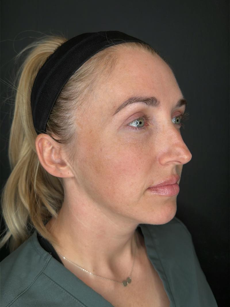 Upper + Lower Blepharoplasty Before & After Gallery - Patient 145946 - Image 4
