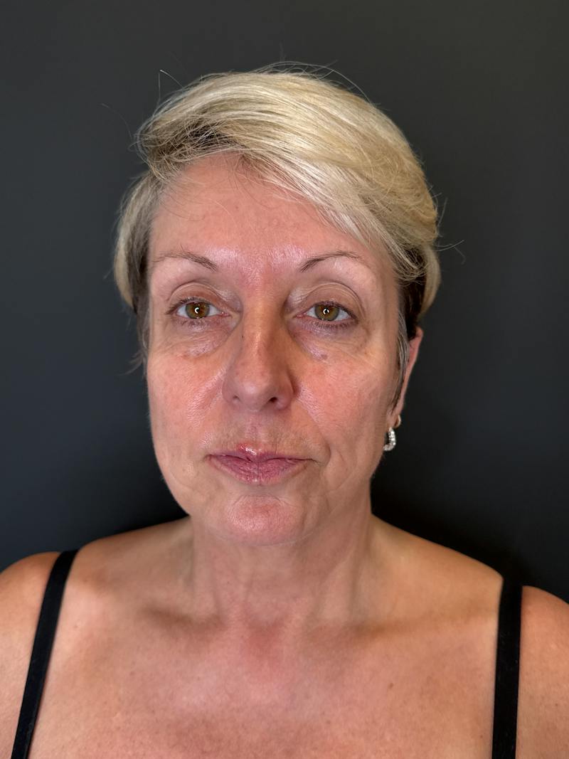 Upper + Lower Blepharoplasty Before & After Gallery - Patient 355193 - Image 1