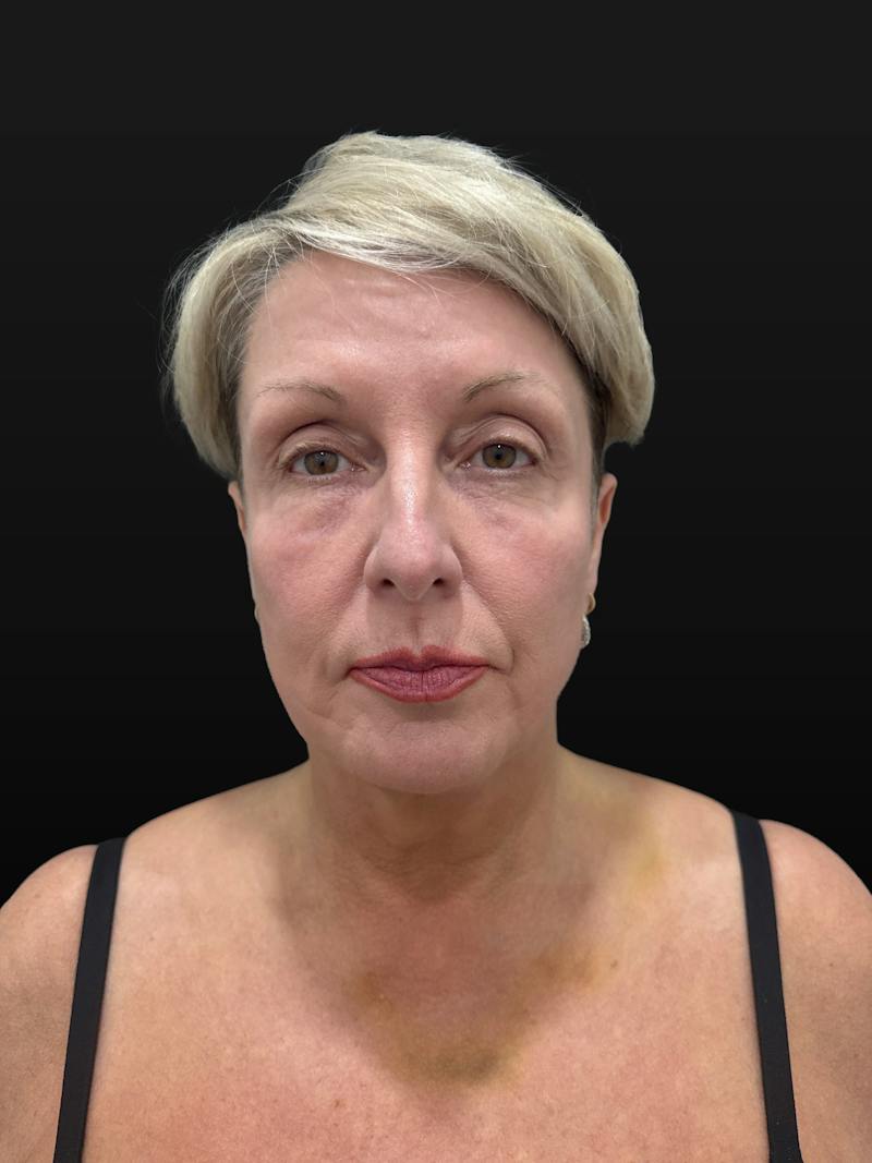 Upper + Lower Blepharoplasty Before & After Gallery - Patient 355193 - Image 2