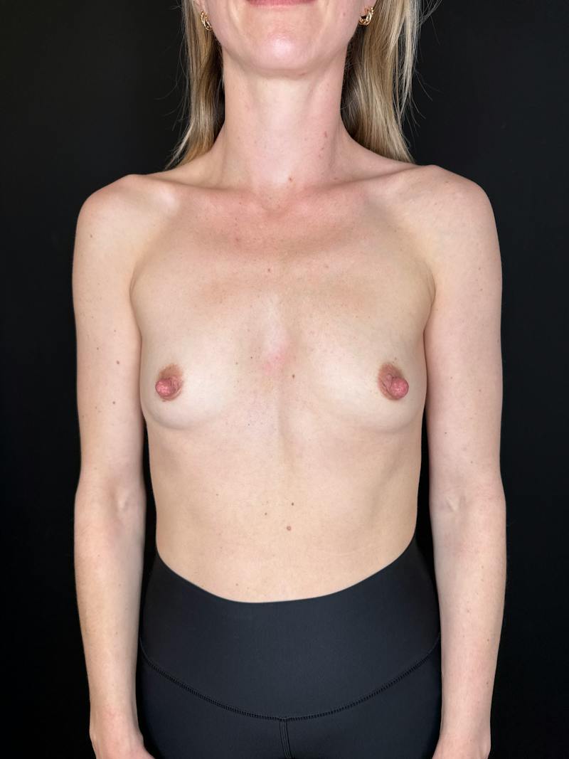 Breast Augmentation Before & After Gallery - Patient 301952 - Image 1