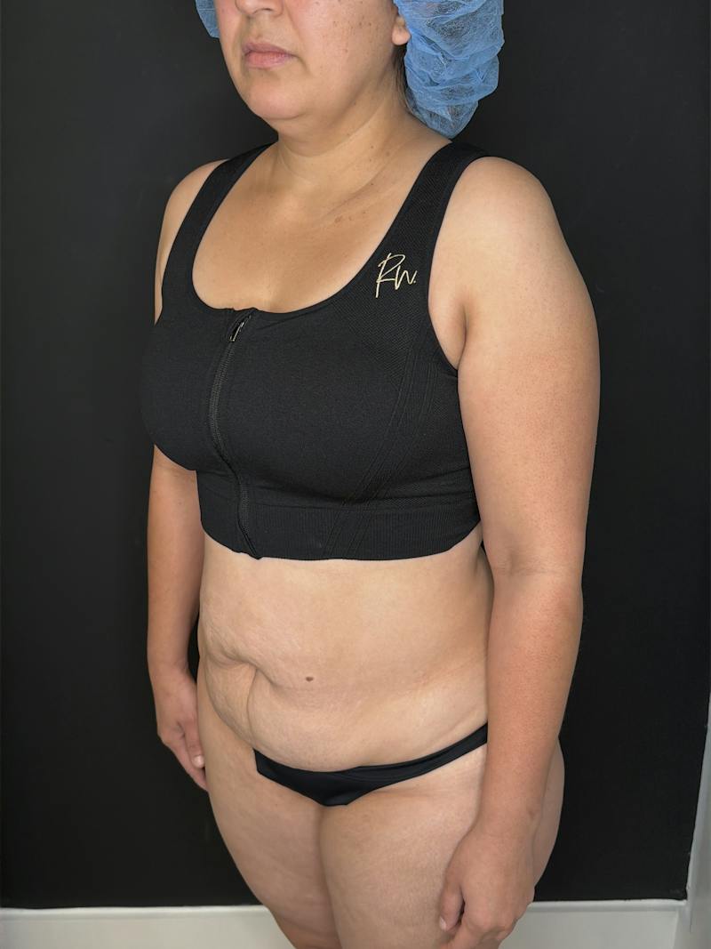 Abdominoplasty (Tummy Tuck) Before & After Gallery - Patient 436675 - Image 1