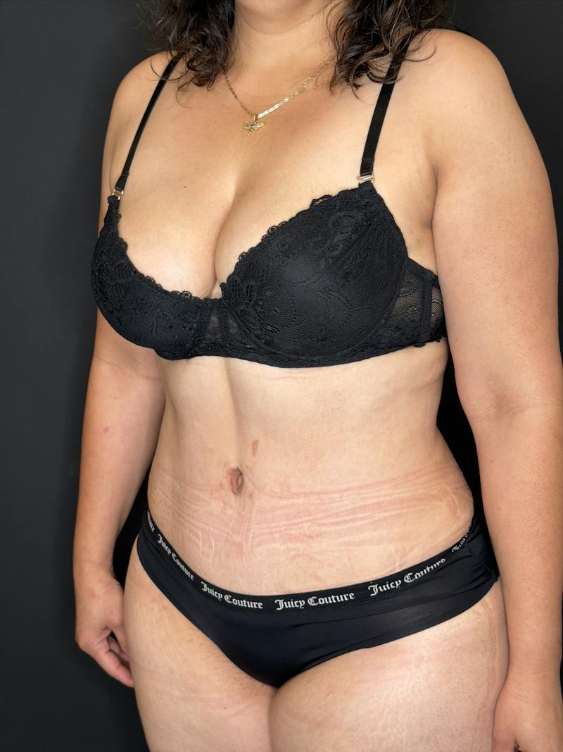 Abdominoplasty (Tummy Tuck) Before & After Gallery - Patient 436675 - Image 2