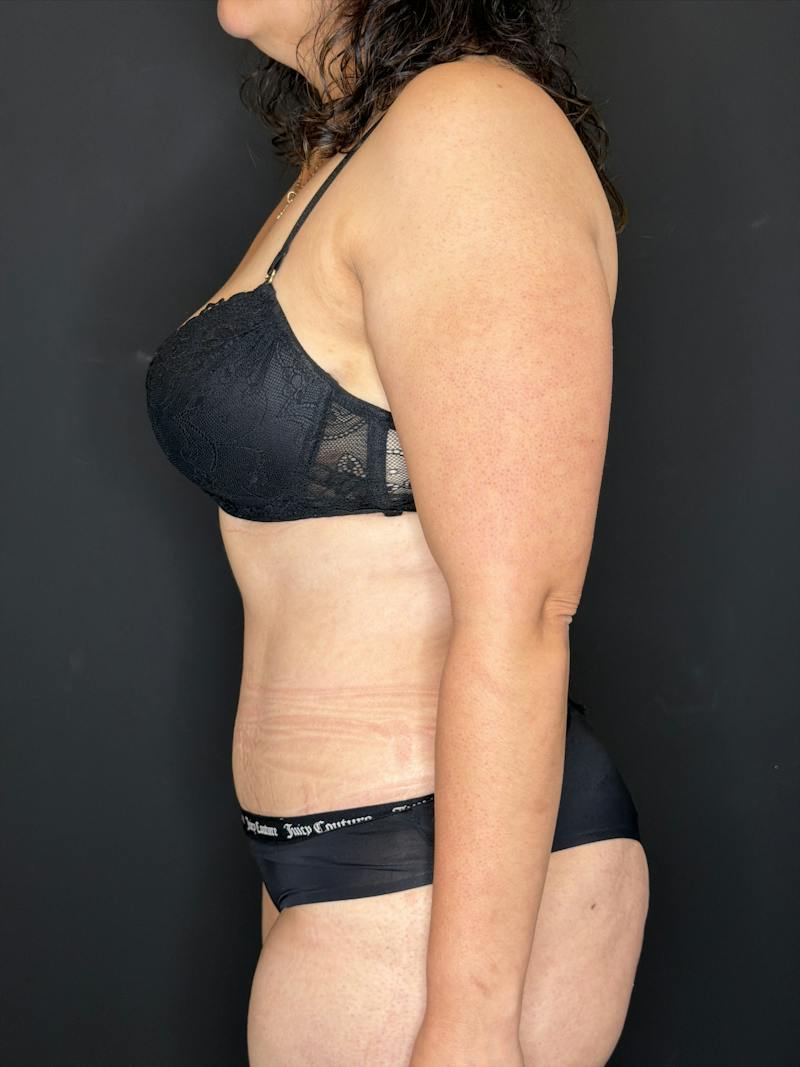 Abdominoplasty (Tummy Tuck) Before & After Gallery - Patient 436675 - Image 4