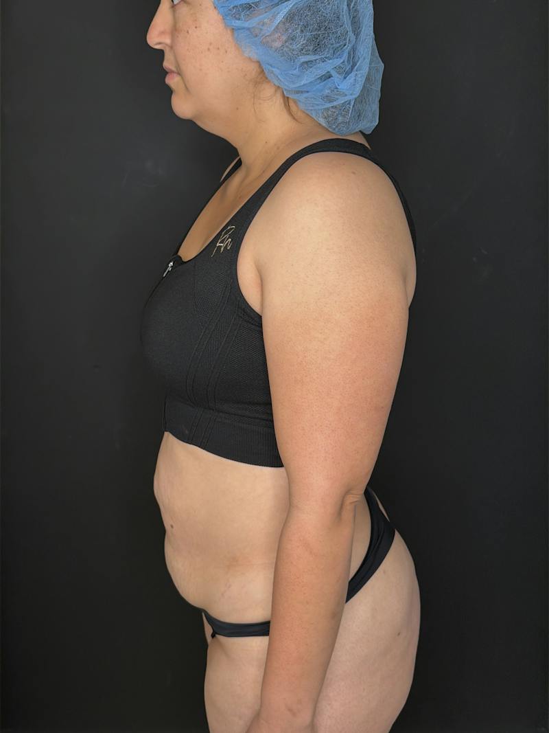 Abdominoplasty (Tummy Tuck) Before & After Gallery - Patient 436675 - Image 3