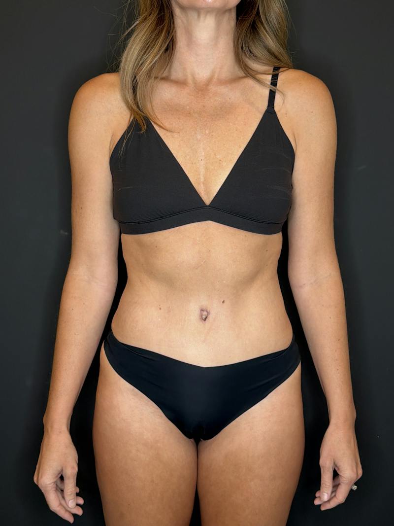 Abdominoplasty (Tummy Tuck) Before & After Gallery - Patient 115706 - Image 2