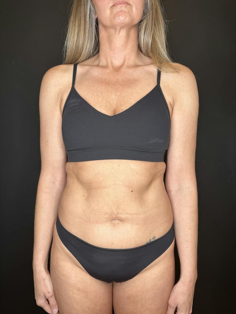 Abdominoplasty (Tummy Tuck) Before & After Gallery - Patient 115706 - Image 1