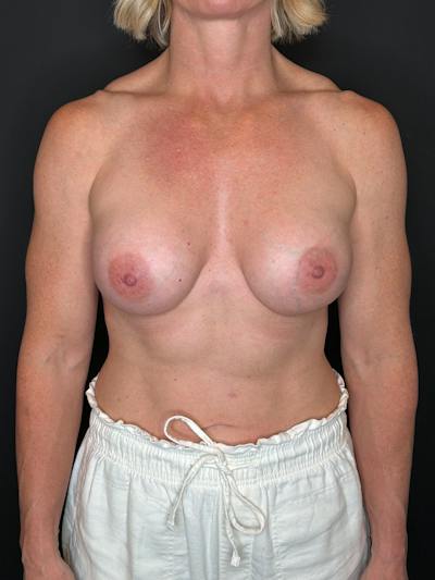 Breast Augmentation Before & After Gallery - Patient 238324 - Image 2