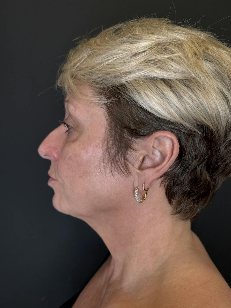 Laser Skin Treatments Before & After Gallery - Patient 351519 - Image 3