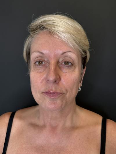 Laser Skin Treatments Before & After Gallery - Patient 351519 - Image 1