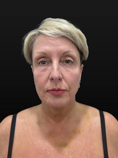 Laser Skin Treatments Before & After Gallery - Patient 351519 - Image 2