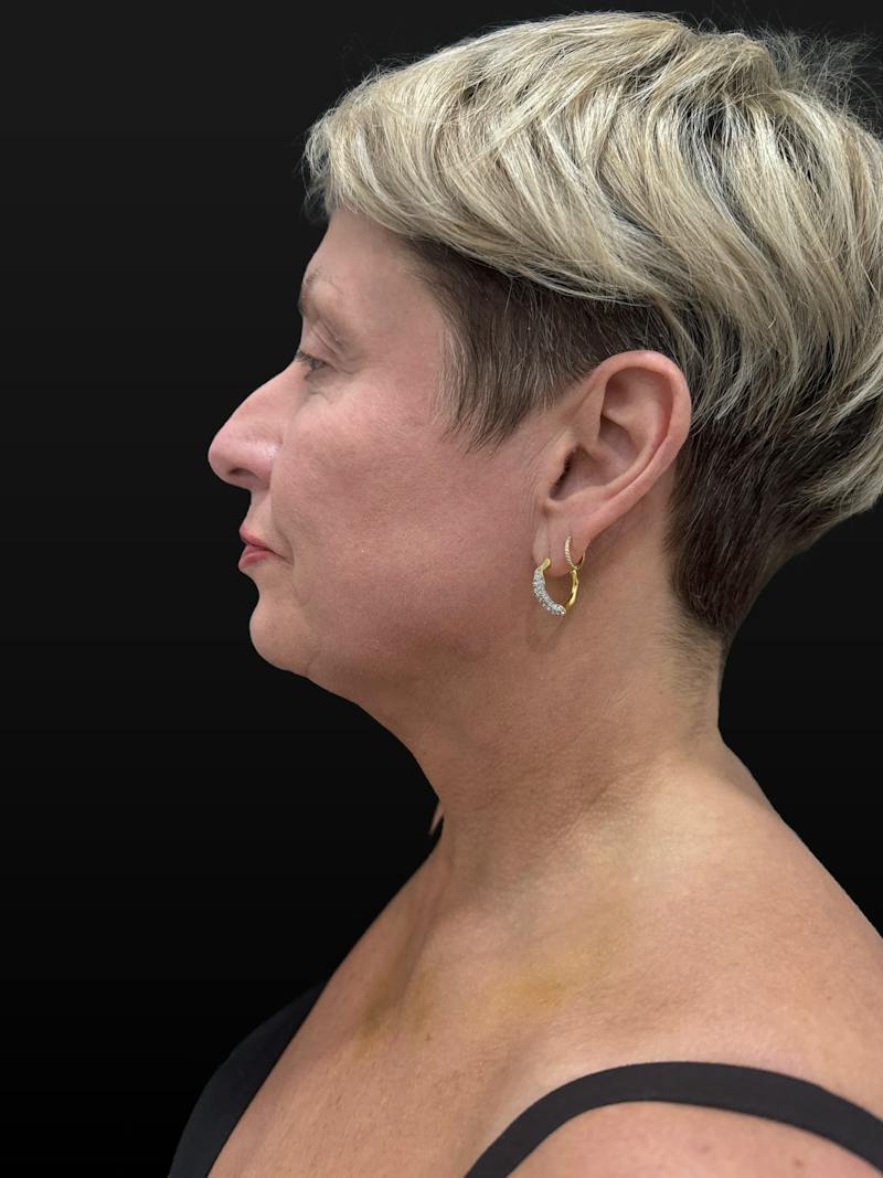Laser Skin Treatments Before & After Gallery - Patient 351519 - Image 4