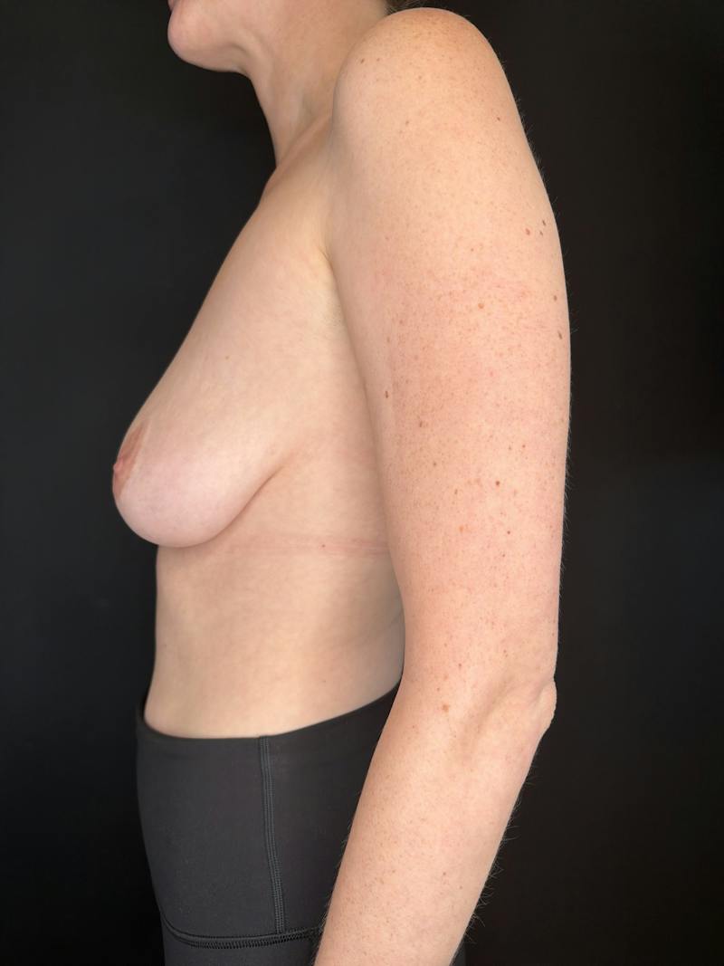 Breast Lift w/ Augmentation Before & After Gallery - Patient 404184 - Image 5