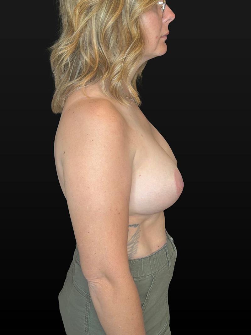 Breast Lift w/ Augmentation Before & After Gallery - Patient 330171 - Image 6
