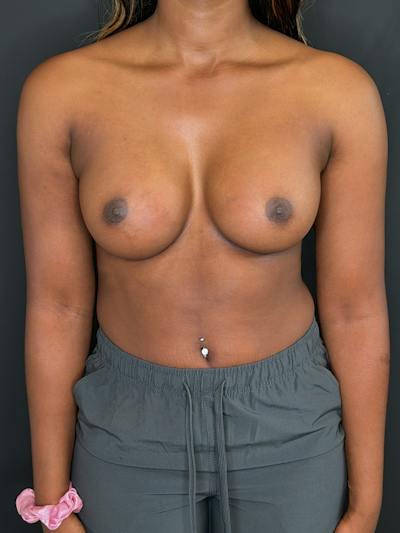 Breast Augmentation Before & After Gallery - Patient 294722 - Image 2