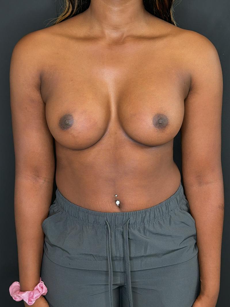 Breast Augmentation Before & After Gallery - Patient 294722 - Image 2