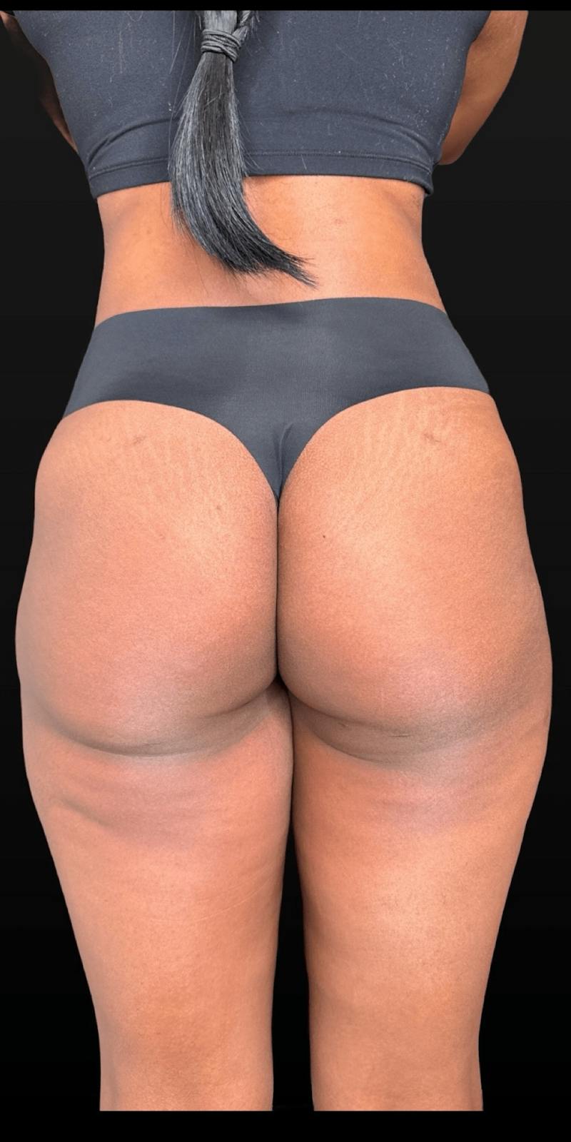 Alloclae Before & After Gallery - Patient 171338 - Image 1