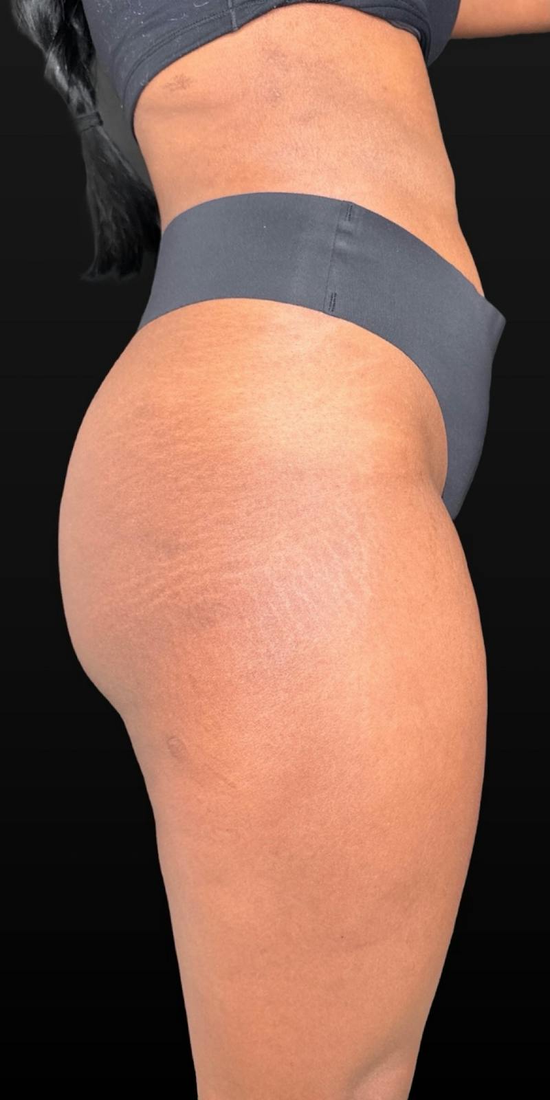 Alloclae Before & After Gallery - Patient 171338 - Image 3