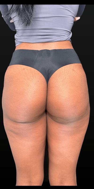 Alloclae Before & After Gallery - Patient 171338 - Image 2